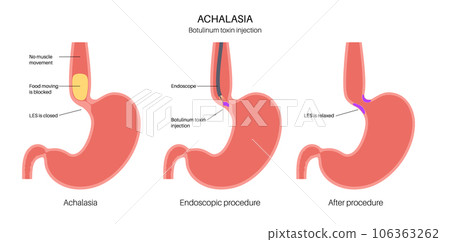 esophageal botulinum toxin injection 106363262