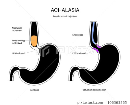 esophageal botulinum toxin injection esophageal botulinum toxin injection 106363265