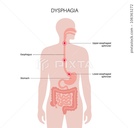 Dysphagia medical poster Dysphagia medical poster 106363272