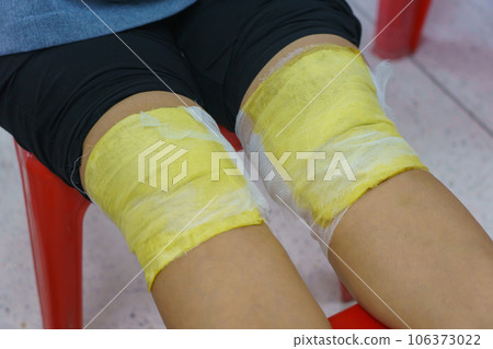 Knee pain relief with herbal. Knee osteoarthritis. Thai traditional medicine 106373022