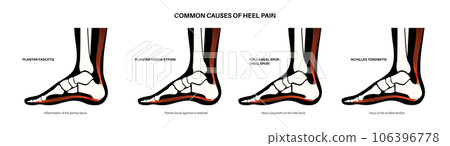 Heel pain diagram 106396778