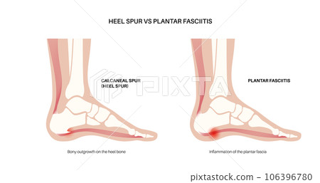 Heel spur and plantar fasciitis 106396780