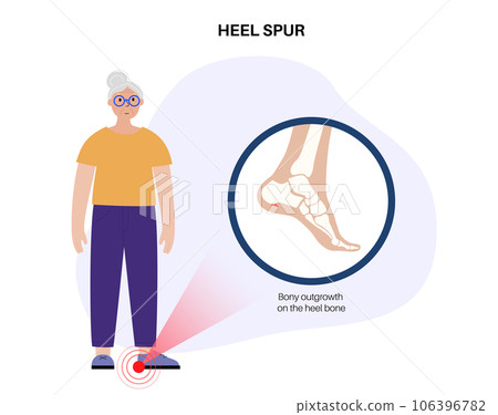 Heel spur poster 106396782