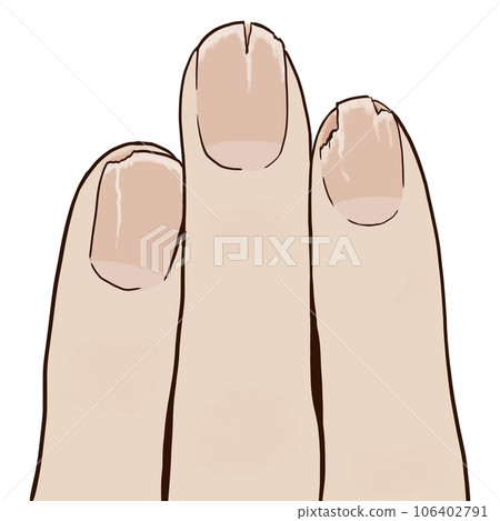 Cracked nails 106402791