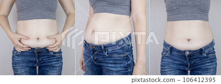 Obesity Cellulite. Folds of excess fat on woman waist. Before and after. Concept of losing weight, playing sports, checking result from diet and intense training. Result of losing weight. Liposuction 106412395