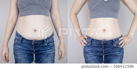 Obesity Cellulite. Folds of excess fat on woman waist. Before and after. Concept of losing weight, playing sports, checking result from diet and intense training. Result of losing weight. Liposuction 106412396