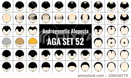 52 types of male pattern baldness. Bald head icon. AGA treatment and progress of thinning hair. Vector illustration. 106416574