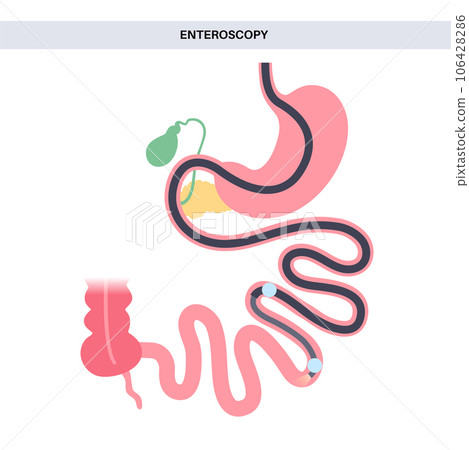 Double balloon enteroscopy - Stock Illustration [106428286] - PIXTA