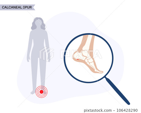 Heel spur poster 106428290