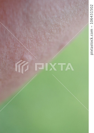 I was bitten by an insect in the field. I was bitten by an insect in the field. 106431502