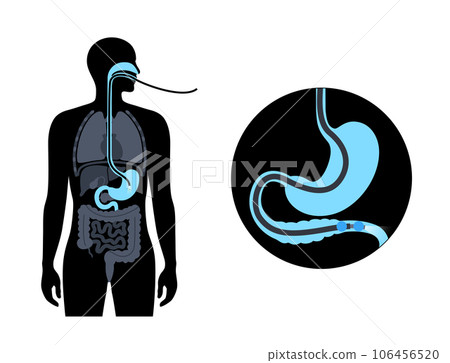 Balloon assisted enteroscopy Balloon assisted enteroscopy 106456520
