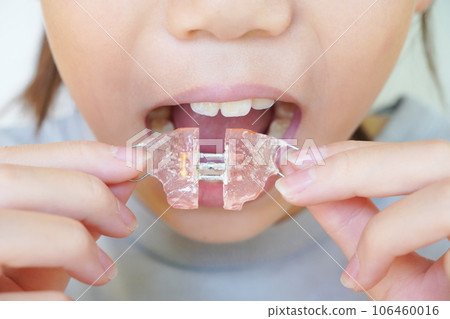 兒童正畸矯治器 106460016