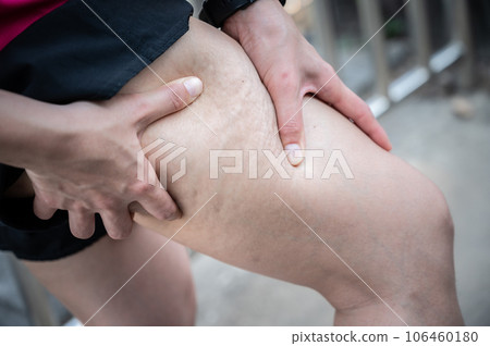 Woman with cellulite (known as orange-peel skin) problem appears on her legs. cellulite It forms when fatty tissue deep in the skin pushes up against connective tissue. Woman with cellulite (known as orange-peel skin) problem appears on her legs. cellulite It forms when fatty tissue deep in the skin pushes up against connective tissue. 106460180