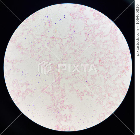 Red cell gram negative bacilli in hemo culture. 106460830