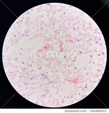 Red cell gram negative bacilli in hemo culture. Red cell gram negative bacilli in hemo culture. 106460832