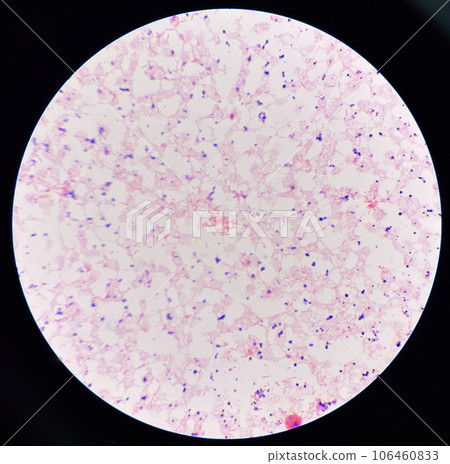 Red cell gram negative bacilli in hemo culture. Red cell gram negative bacilli in hemo culture. 106460833
