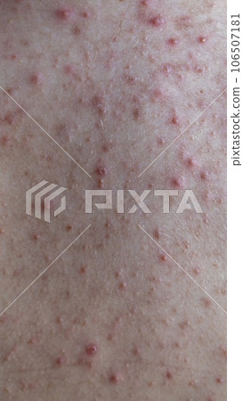woman back with acne, red spots, skin disease woman back with acne, red spots, skin disease 106507181