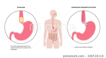 Endoscopic pneumatic dilation 106516118