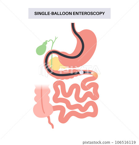 Single balloon enteroscopy 106516119