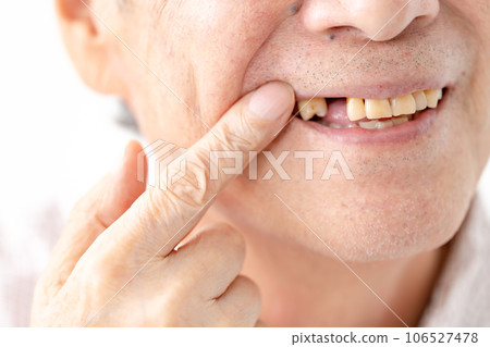 Senior male missing teeth dental 106527478