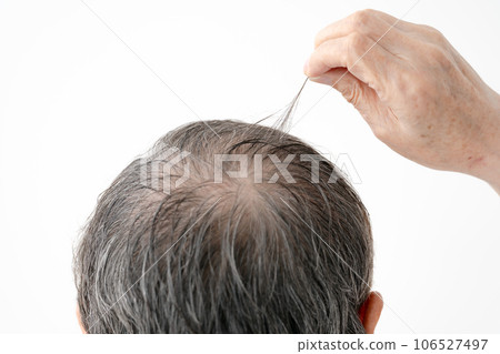 Thin hair AGA male 106527497