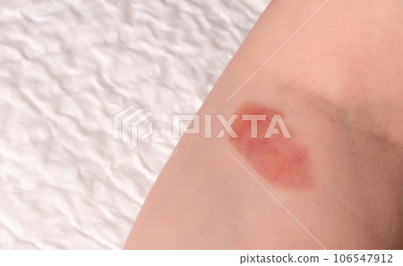Red spot on the skin, skin damage from a burn on the arm. Copy space for text 106547912