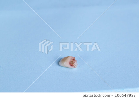 Children's milk tooth on a blue background. The concept of tooth extraction in children. Children's dentistry. Copy space for text Children's milk tooth on a blue background. The concept of tooth extraction in children. Children's dentistry. Copy space for text 106547952