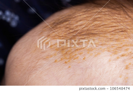 Milk crusts on the head of a newborn child, gneiss. The formation of yellow-golden scales on the head of an infant, close-up 106548474