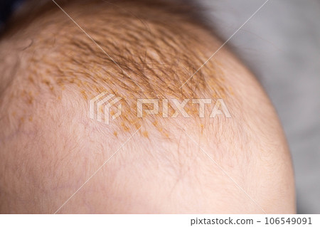 Seborrheic dermatitis on the skin on the head of a 6 month old baby. Yellow scales on the head, close-up Seborrheic dermatitis on the skin on the head of a 6 month old baby. Yellow scales on the head, close-up 106549091