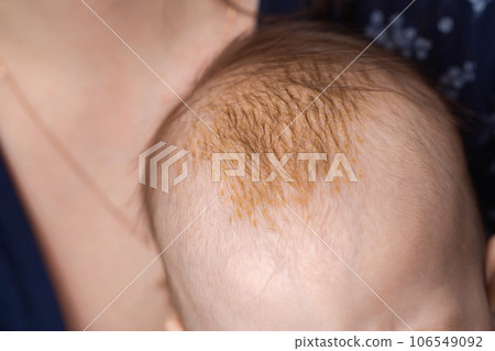Seborrheic dermatitis on the skin on the head of a 6 month old baby. Yellow scales on the head, close-up 106549092