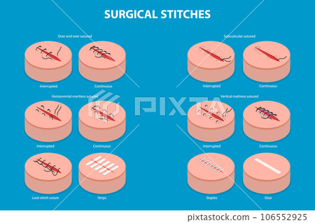3D Isometric Flat Vector Conceptual Illustration of Surgical Stitches 106552925