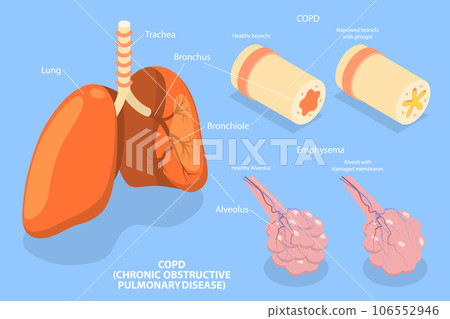 3D Isometric Flat Vector Conceptual Illustration of COPD 3D Isometric Flat Vector Conceptual Illustration of COPD 106552946