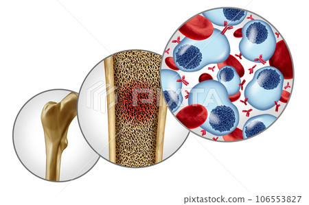 Multiple Myeloma 106553827