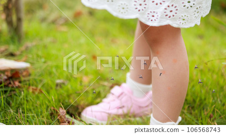 cute asian little girl has skin rash and allergy from mosquito bite and sucking blood at legs while playing on green grass field outdoor cute asian little girl has skin rash and allergy from mosquito bite and sucking blood at legs while playing on green grass field outdoor 106568743