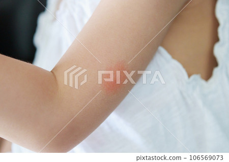 Little girl has skin rash and allergy from mosquito bite 106569073