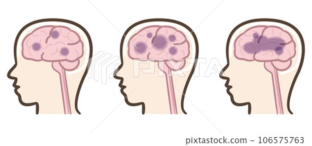 Alzheimer's disease brain illustrations 106575763