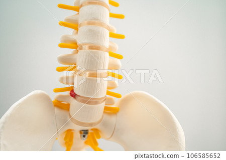 Lumbar spine displaced herniated disc fragment, spinal nerve and bone. Model for treatment medical in the orthopedic department. Lumbar spine displaced herniated disc fragment, spinal nerve and bone. Model for treatment medical in the orthopedic department. 106585652