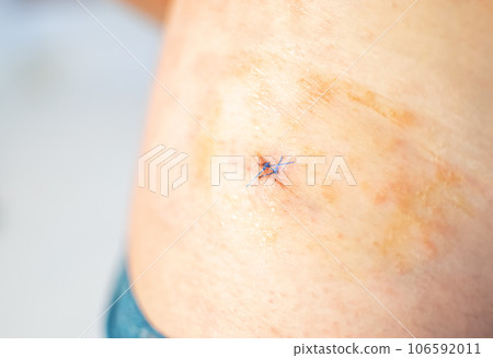 Hip and leg with wound and stitches showing healing and sterilization measures Hip and leg with wound and stitches showing healing and sterilization measures 106592011