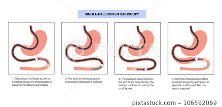 Single balloon enteroscopy 106592069