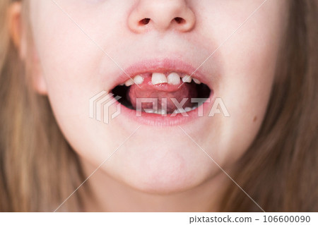 portrait of a little child girl moving her milk front tooth with her tongue in open mouth. portrait of a little child girl moving her milk front tooth with her tongue in open mouth. 106600090