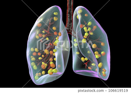 Lung histoplasmosis, a fungal infection caused by Histoplasma capsulatum, 3D illustration 106619519