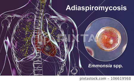 Lung adiaspiromycosis and close-up view of Emmonsia fungi, 3D illustration Lung adiaspiromycosis and close-up view of Emmonsia fungi, 3D illustration 106619568