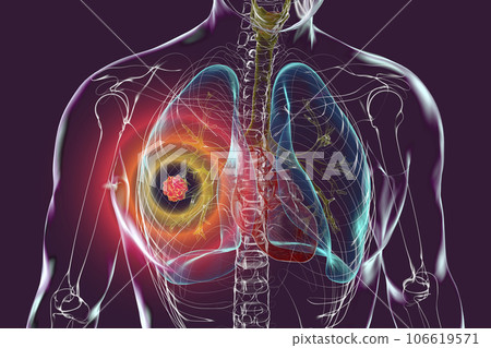 Lung cancer, 3D illustration 106619571