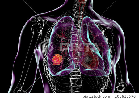 Lung cancer, 3D illustration 106619576