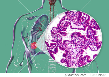 Lung cancer, 3D illustration and light micrograph 106619586