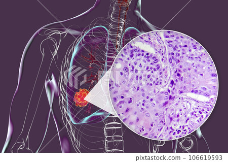 Lung cancer, 3D illustration and light micrograph 106619593