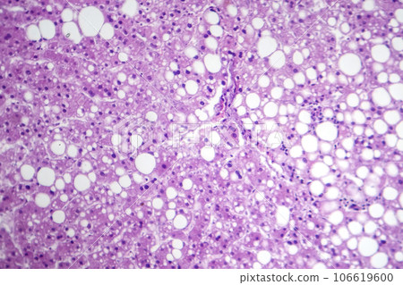 Hepatic steatosis, light micrograph Hepatic steatosis, light micrograph 106619600