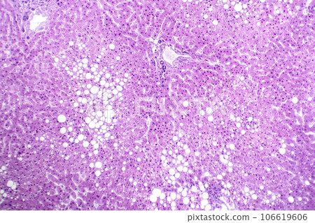 Hepatic steatosis, light micrograph Hepatic steatosis, light micrograph 106619606