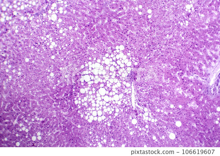 Hepatic steatosis, light micrograph 106619607