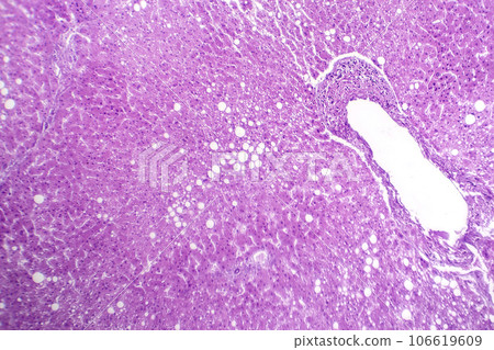 Hepatic steatosis, light micrograph 106619609